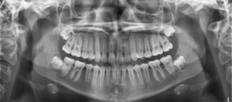 Radiografia de maxilar y mandibula